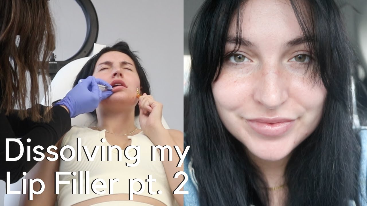 Dissolving Lip Fillers (Before and after with hyaluronidase) Vlog pt. 2