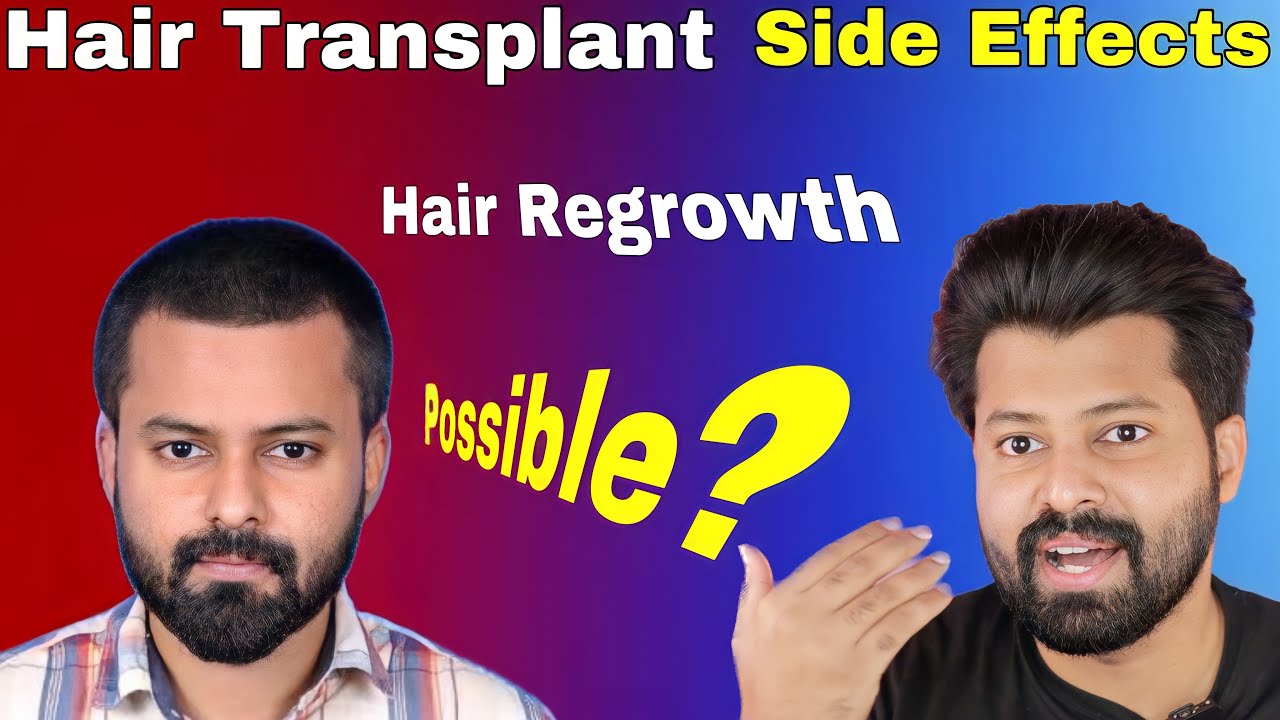 Hair Transplant PRP GFC Side Effects | Bald Hair Regrowth Possible ? Ask Doctor Part 1
