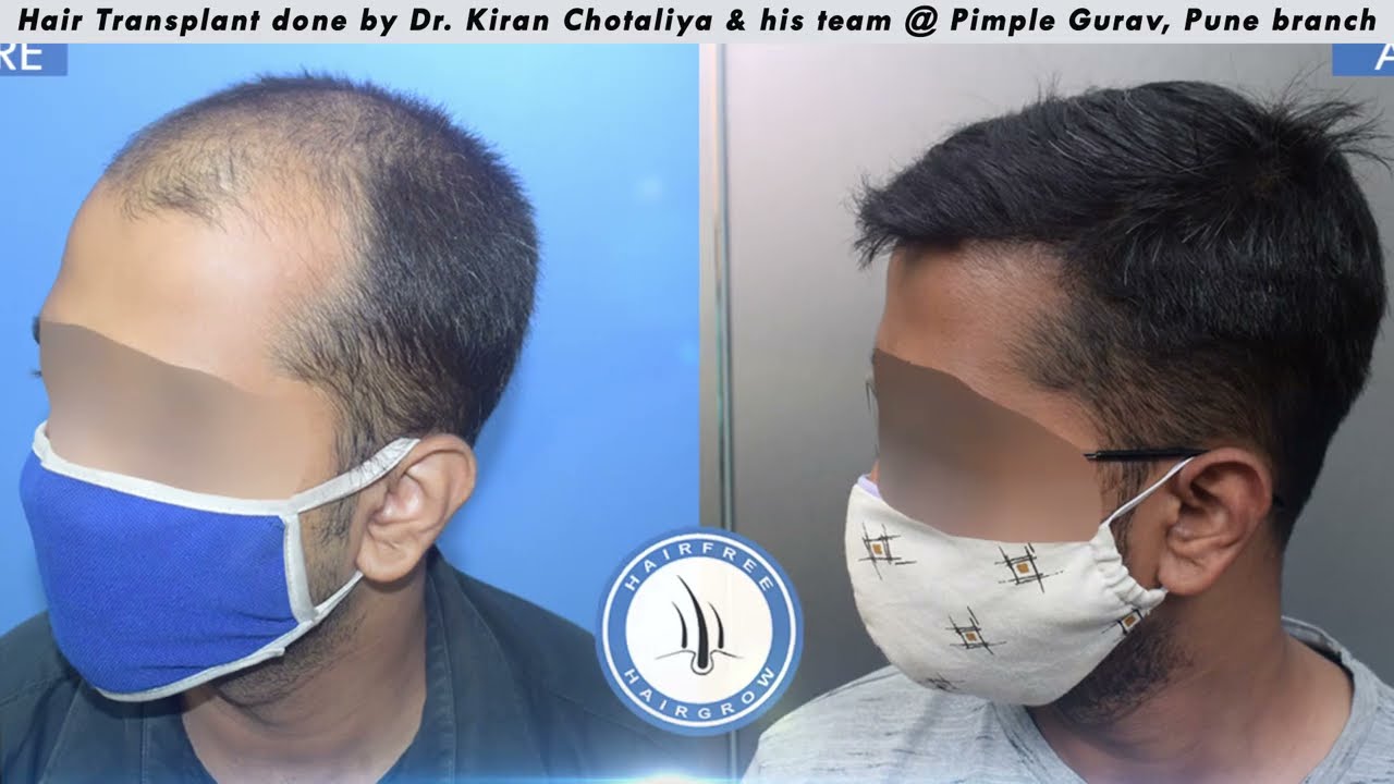 High Density Hair Transplant Result by Dr. Kiran Chotaliya & team || Pune - pimple Gurav branch