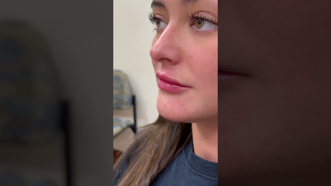 Lip filler transformation with Restylane Kysse 😍
