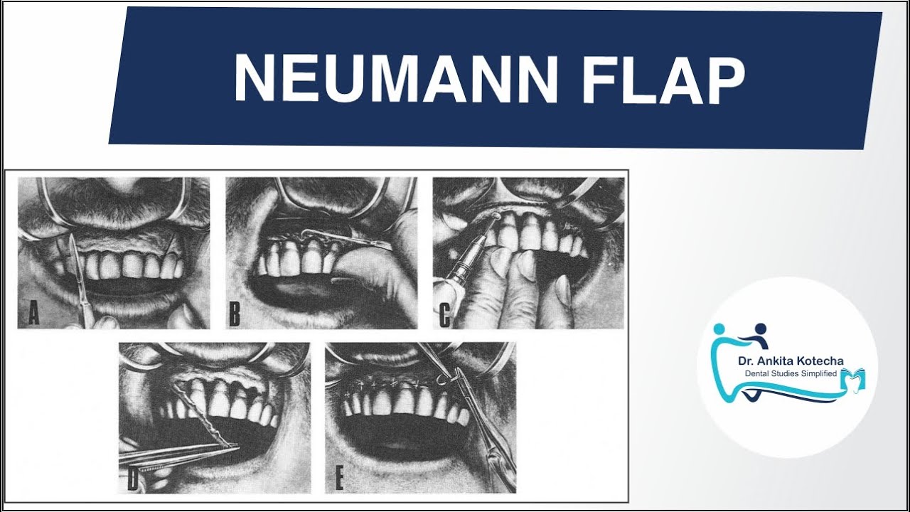 NEUMANN FLAP/ PERIODONTAL FLAP SURGERY TECHNIQUE/ DR. ANKITA KOTECHA/ DENTAL STUDIES SIMPLIFIED
