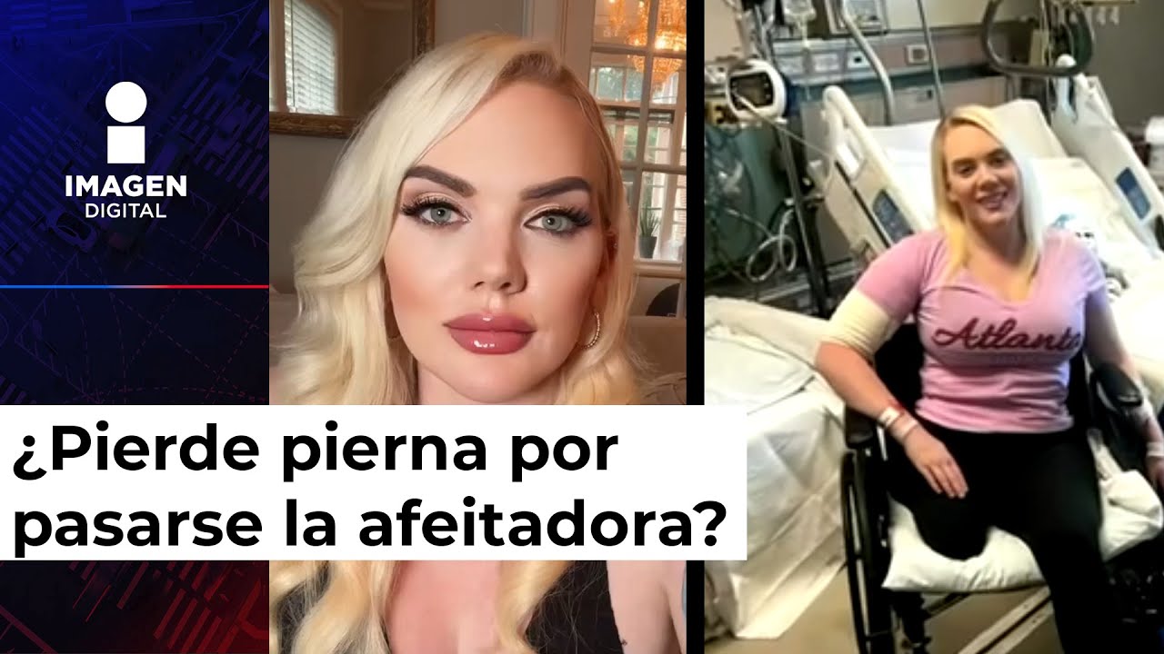 Amputan una pierna a modelo tras infectarse con una bacteria carnívora
