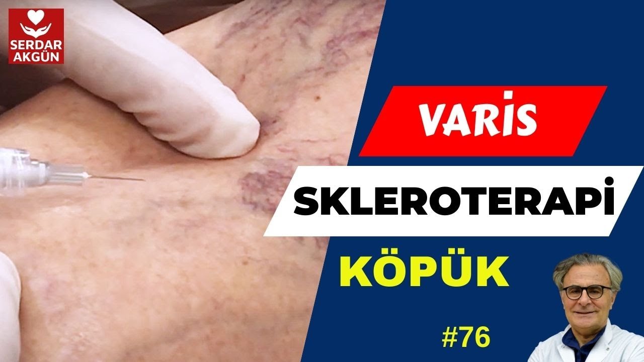 76. Varis Tedavisi, Köpük Tedavisi Nasıl Olur? , Kılcal Damarlar., Serdar Akgün