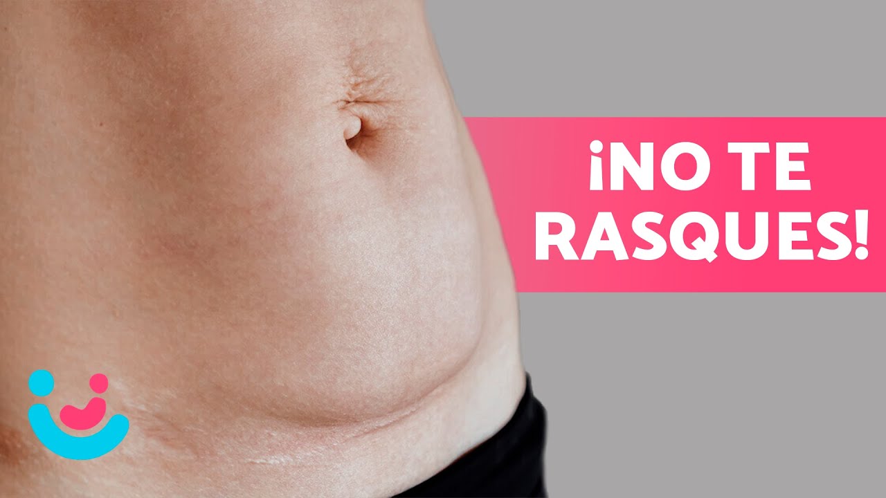 &iquest;C&oacute;mo CUIDAR la CICATRIZ de una CES&Aacute;REA? 🤰🏻👨🏻&zwj;⚕️ &iquest;Cu&aacute;ndo Retirar los Puntos? &iquest;Qu&eacute; No se Debe Hacer?