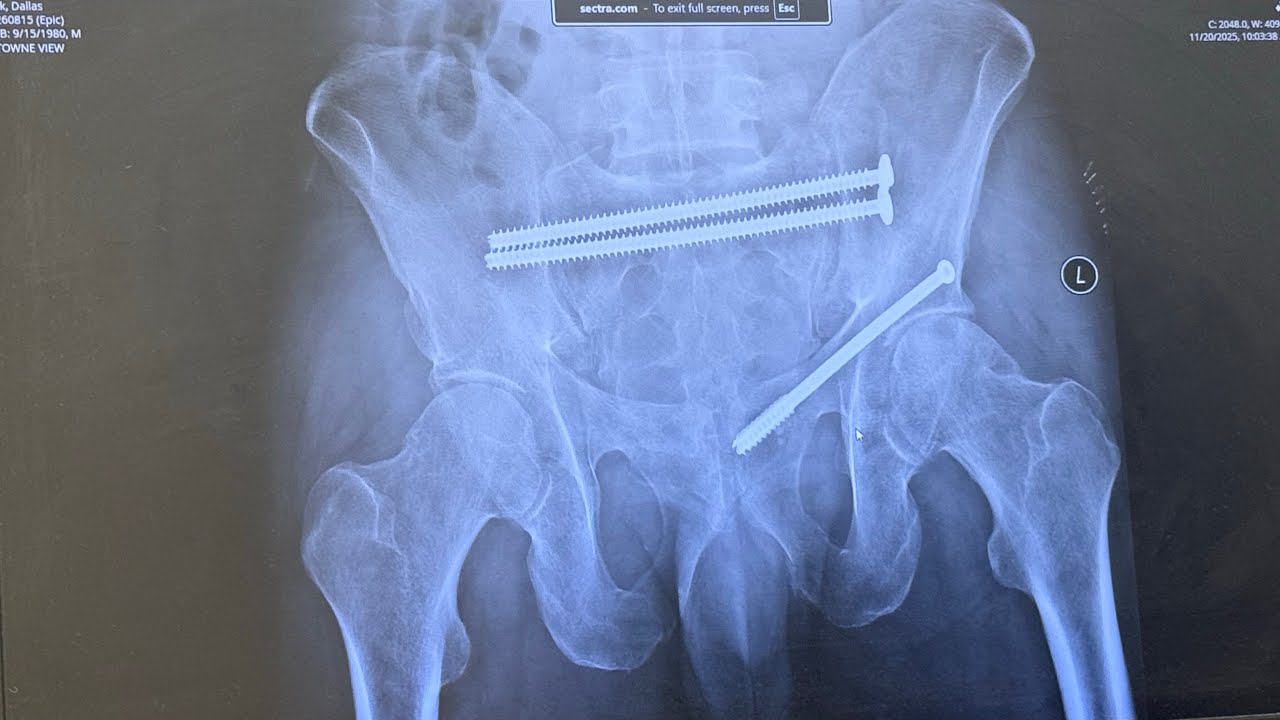 Bad motocross crash, asking for donations- gofund.me/f83621dc9