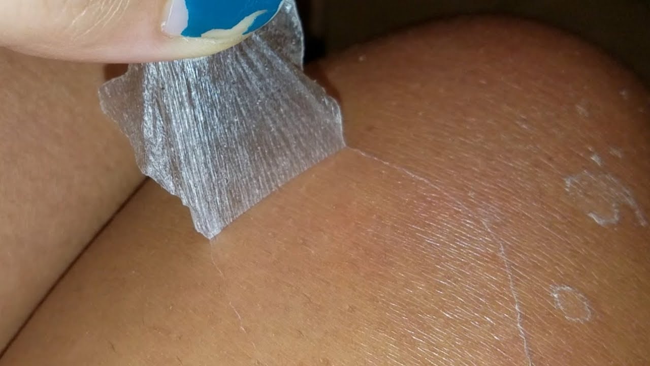Satisfying Sunburn Skin Peeling | VlogGrrr