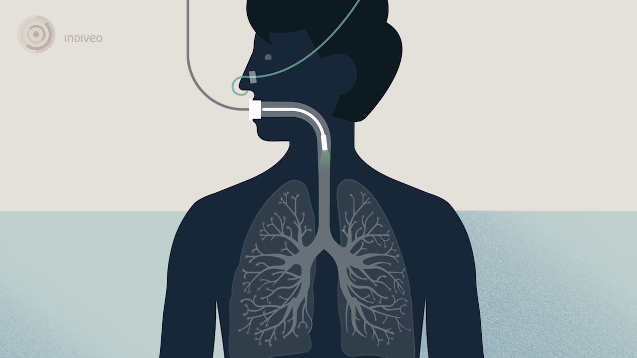 Bronchoscopy - examination of your airways (English version)