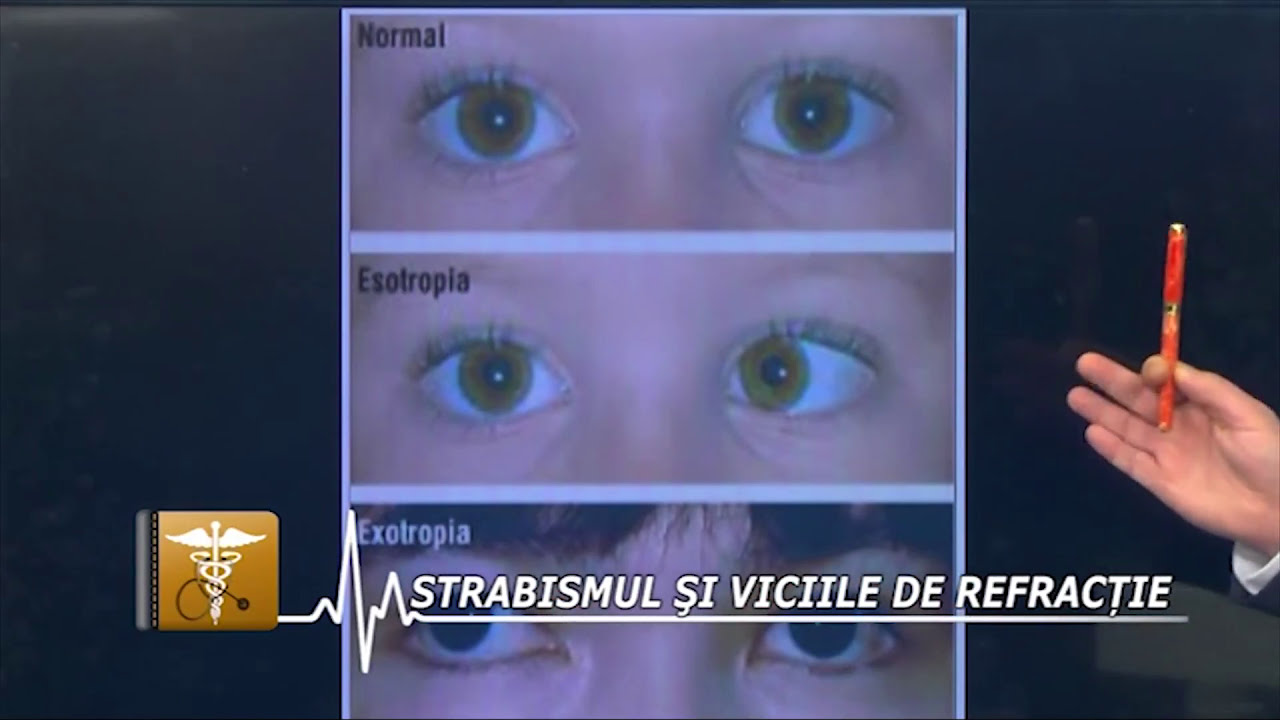 Strabismul explicat de oftalmolog (I)