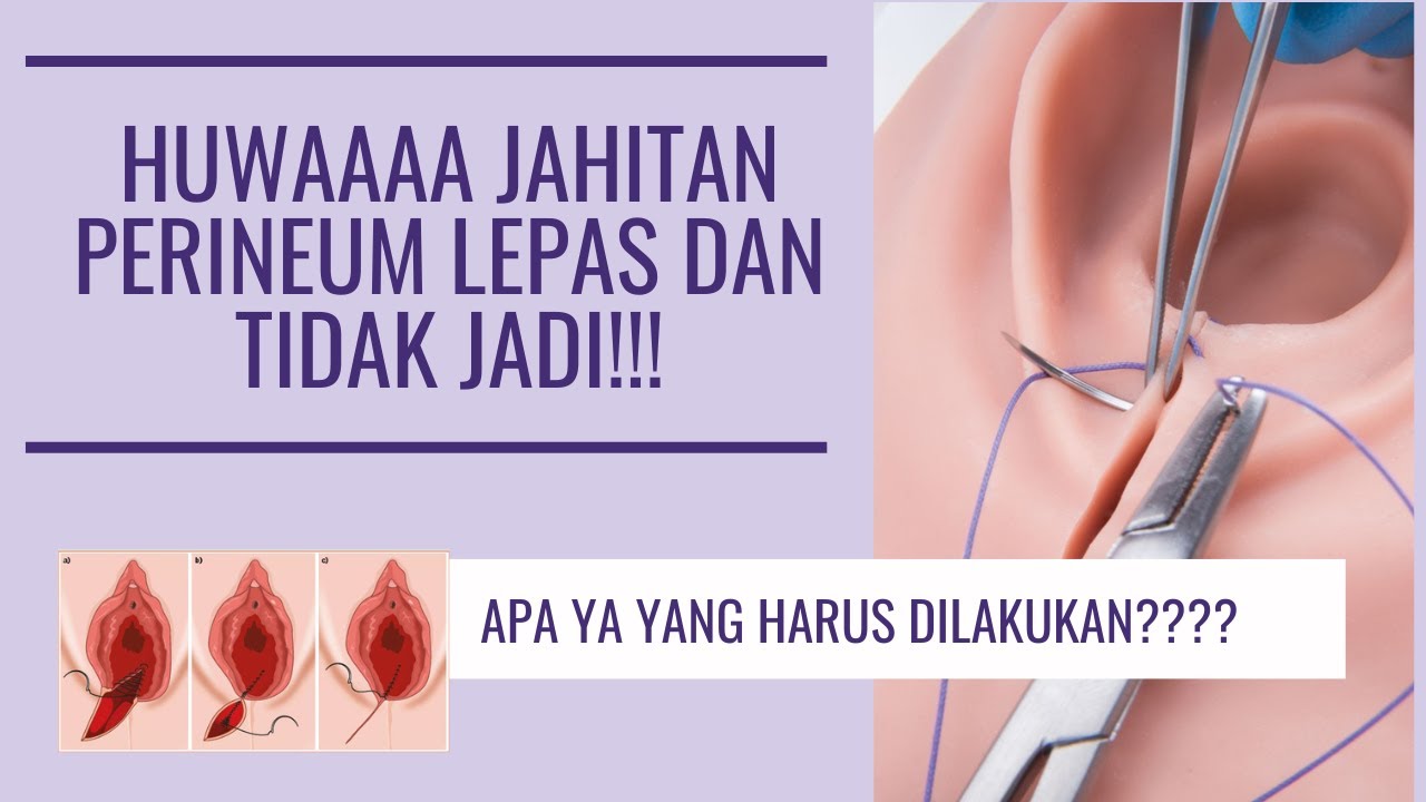 JAHITAN PERINEUM TERBUKA DAN TIDAK JADI, HARUS GIMANA YA?