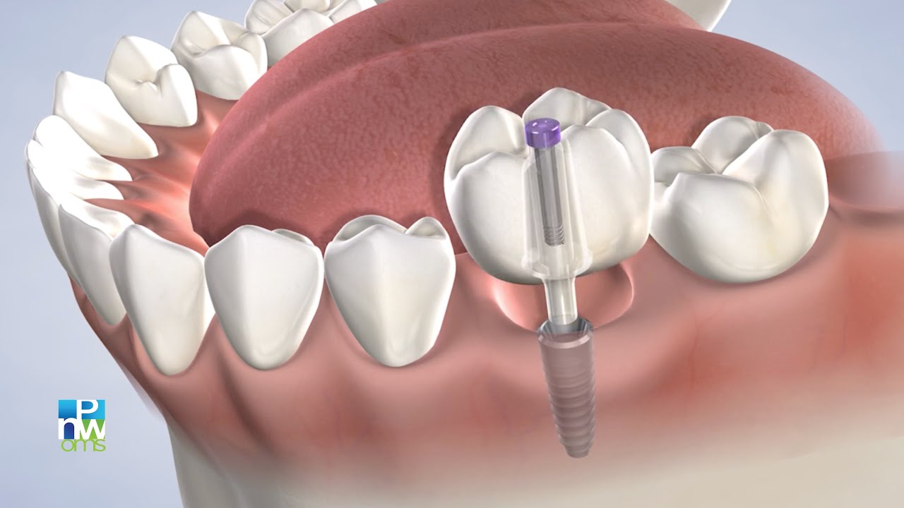 Dental Implant Quality in King County WA: Dr. Carl | Pacific Northwest Oral & Maxillofacial Surgeons