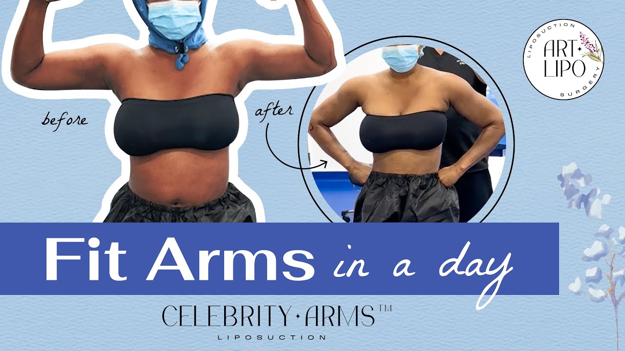 Arm Liposuction Immediate Results | Celebrity Arms&trade; | Expert Dr. Thomas Su