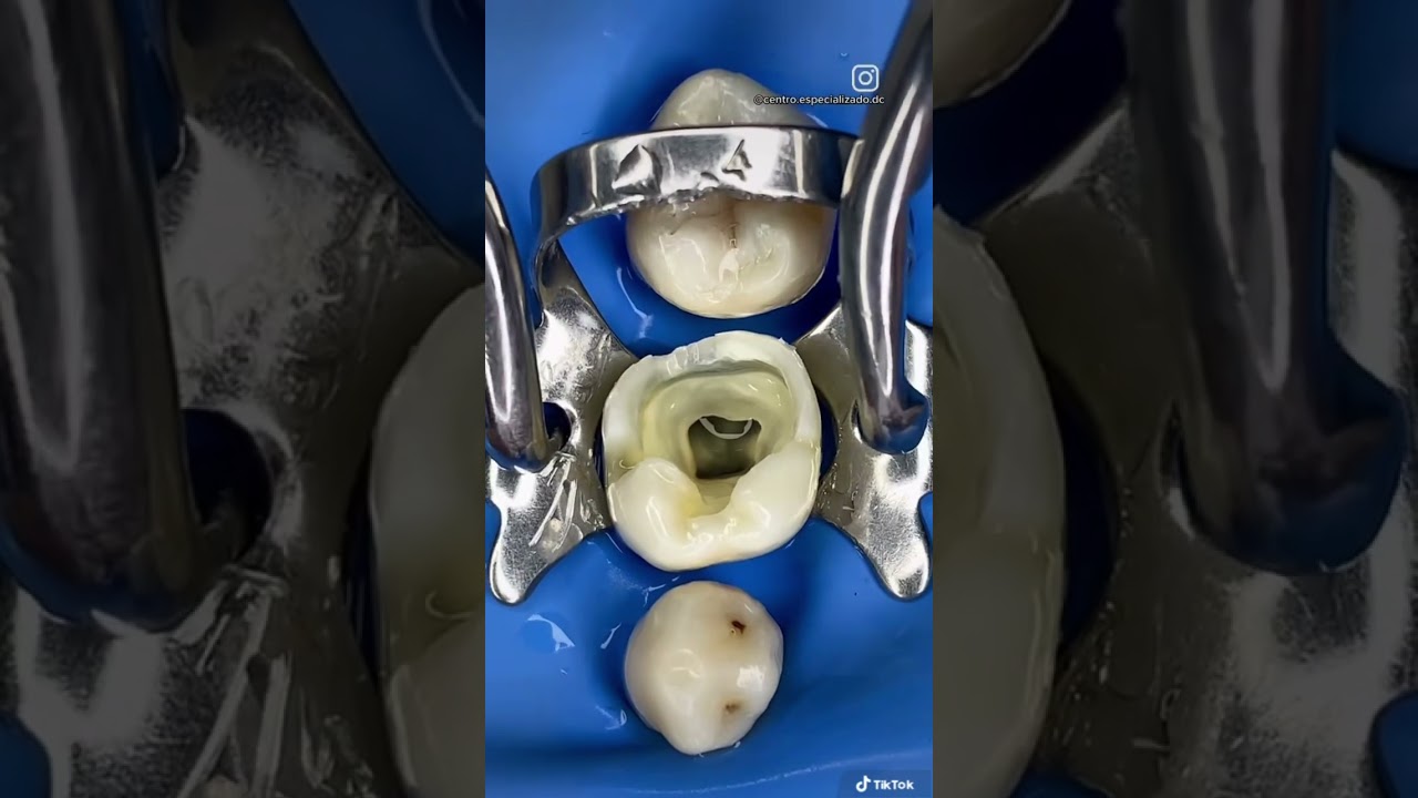 &ldquo;Grapa dental para aislamiento absoluto&rdquo;