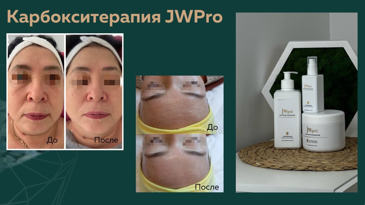 Карбокситерапия JWPro