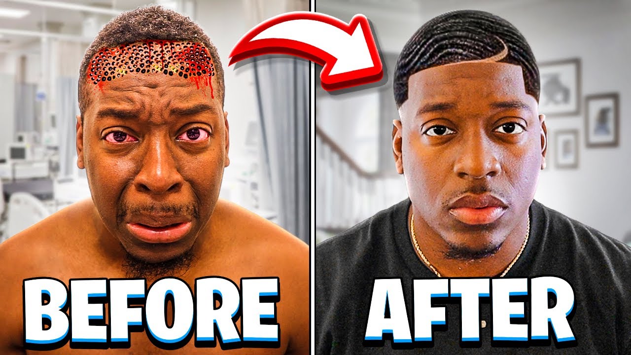 THE REVEAL OF DAMIEN'S SURGICAL HAIRLINE **SHOCKING RESULTS**