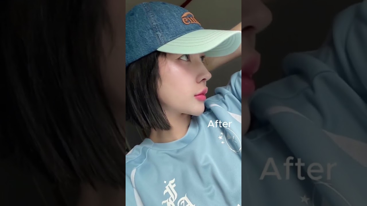 Korea Rhinoplasty Before and After