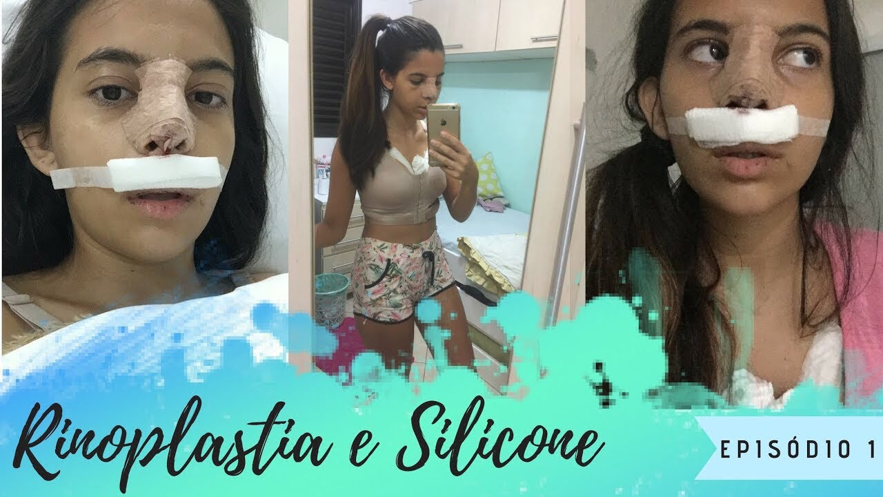 FIZ RINOPLASTIA E COLOQUEI SILICONE - olha no que deu !! - DIÁRIO DA CIRURGIA
