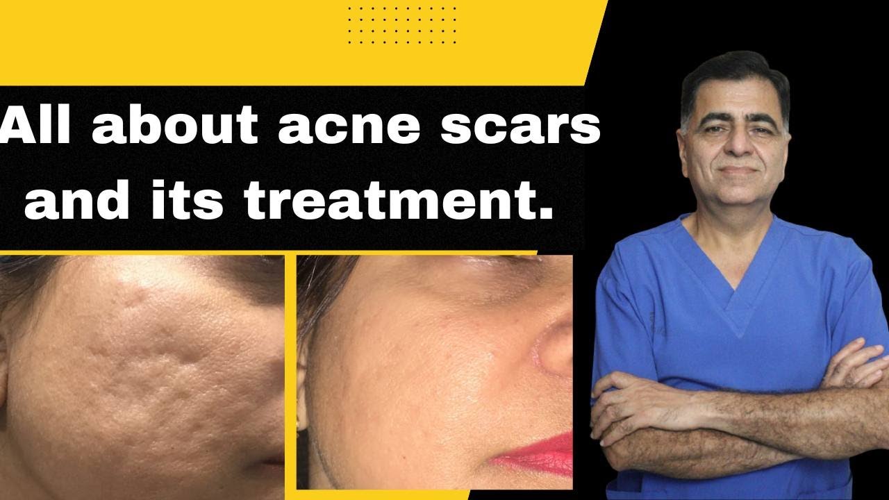 Treatment of acne scars || Dr. S. K. Gulati