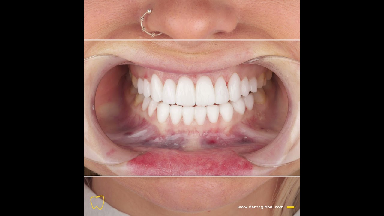 B/A Series #19 Glossy new set of E-max Veneers, see how good they look! 🤩