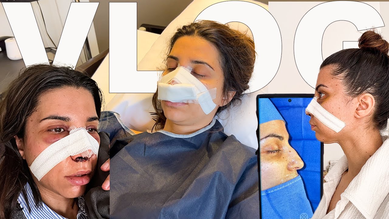 MA RHINOPLASTIE | JOUR J, CONVALESCENCE PARTIE 1 | VLOG | ROSEANDMUSC