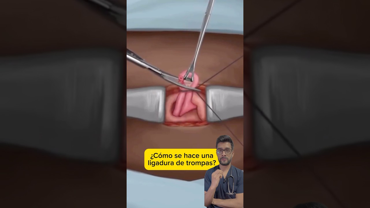 ¿Cómo se hace una ligadura de trompas? ✂️🧵 
