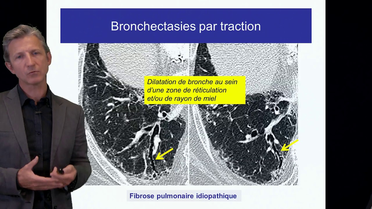 Fibrose pulmonaire Cottin Cours DES 2017 criteres diagnostiques FPI