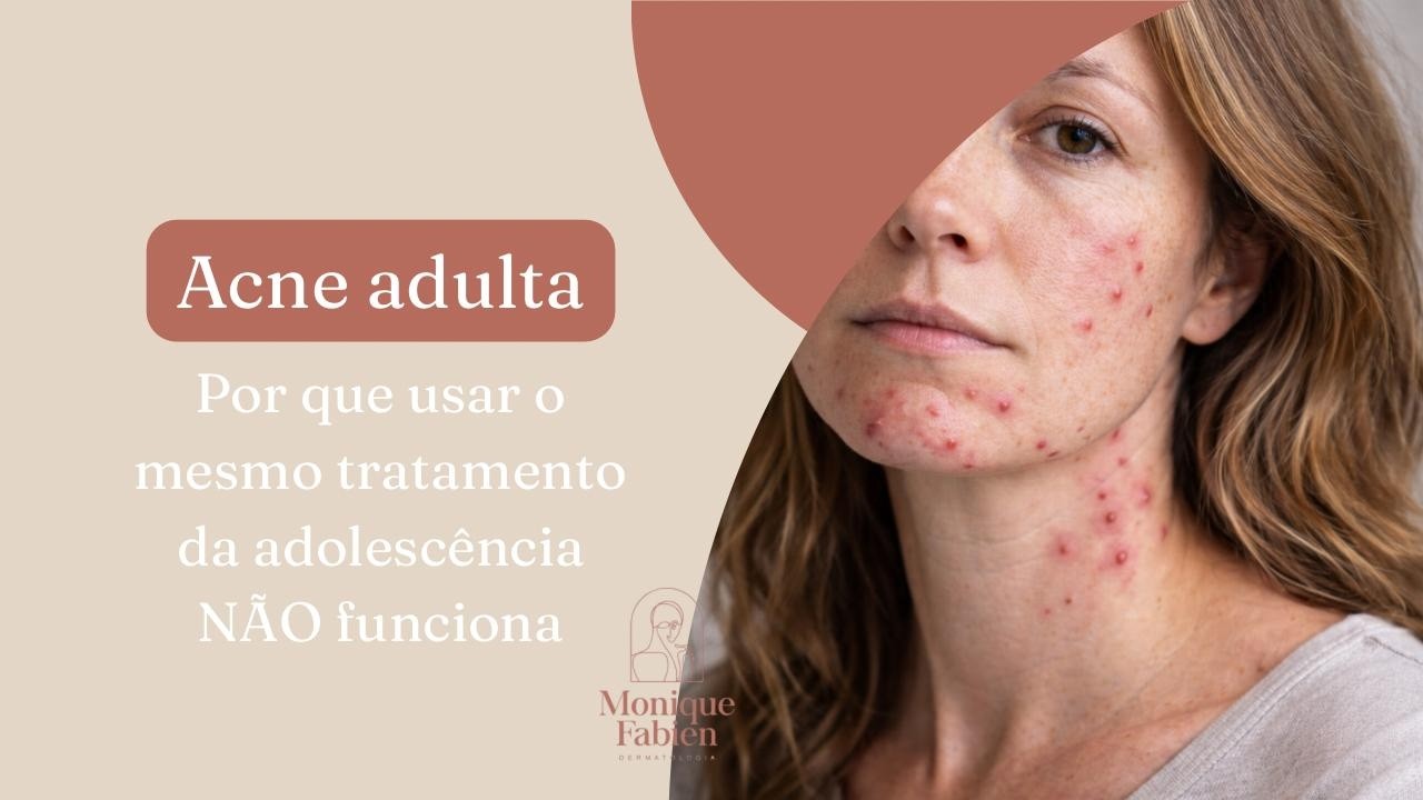 Acne adulta: por que usar o mesmo tratamento da adolescência não funciona!