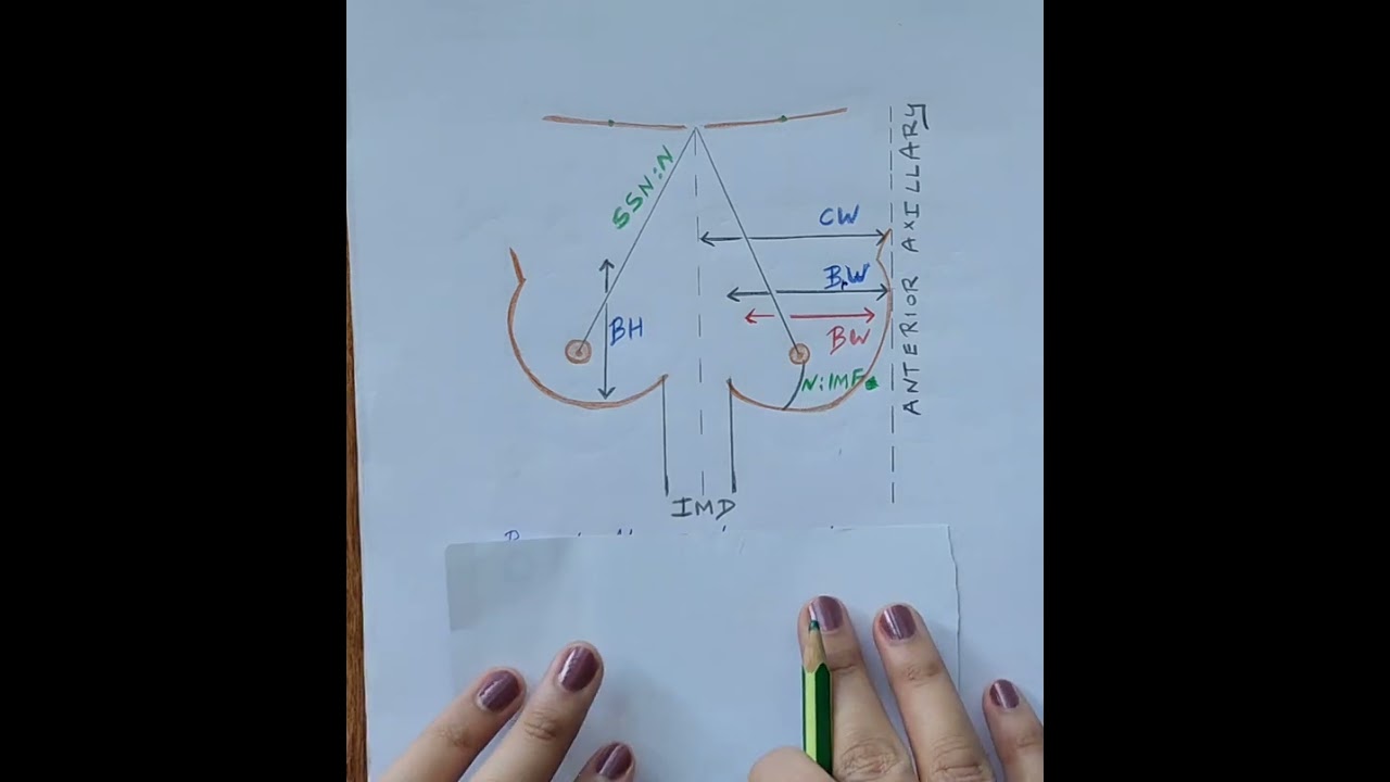 Breast augmentation - Markings