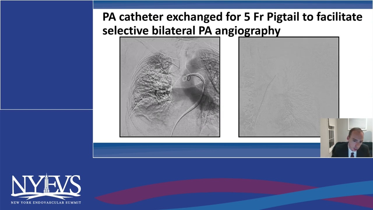 Case 4  New Technology Spotlight from Penumbra Managing Venous Thrombus with Lightning Flash Comput