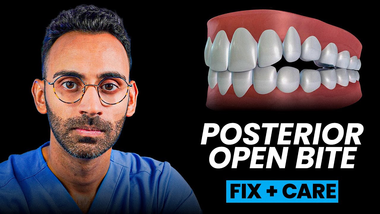 How To Fix Posterior Open Bites Caused By Invisalign/Aligners