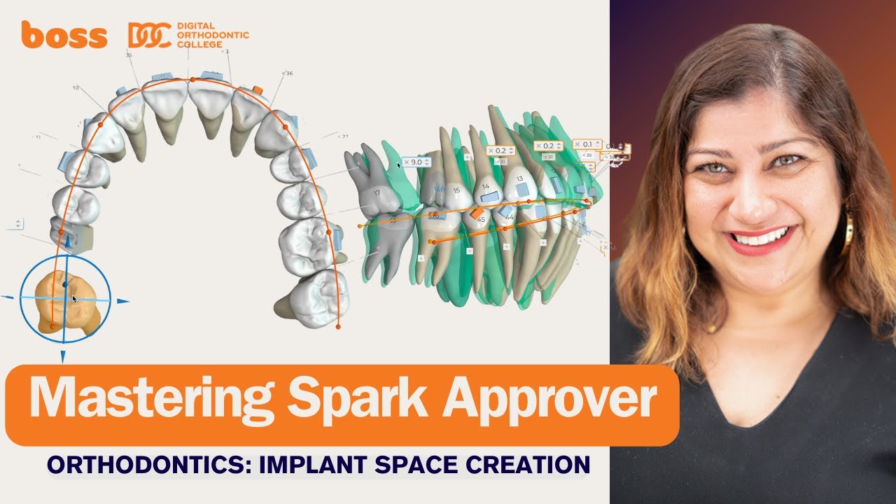 Master Spark Approver: Orthodontic planning for upper molar implant space & asymmetric distalisation