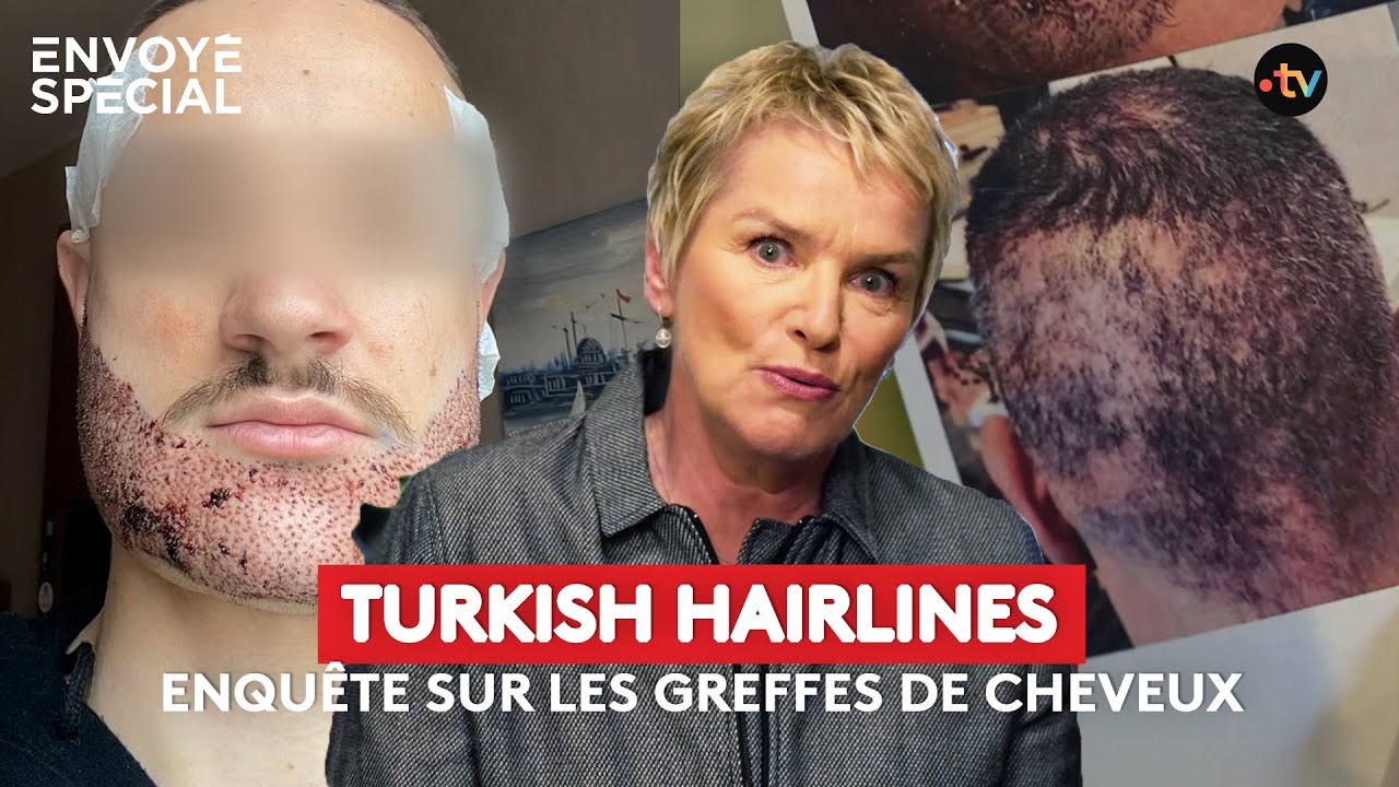 Turkish hairlines, enquête sur la greffe de cheveux - extrait