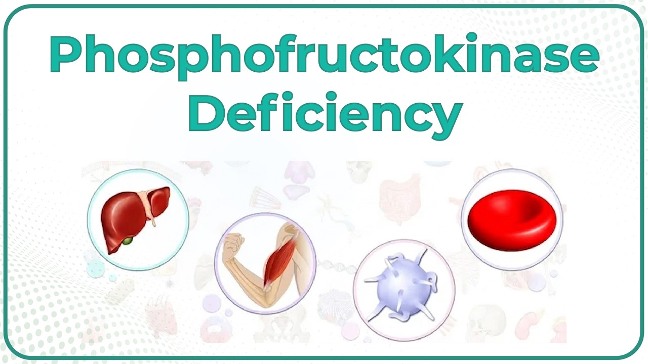 Phosphofructokinase deficiency Animation (Tarui disease / Glycogen-Storage Disease Type VII )  USMLE