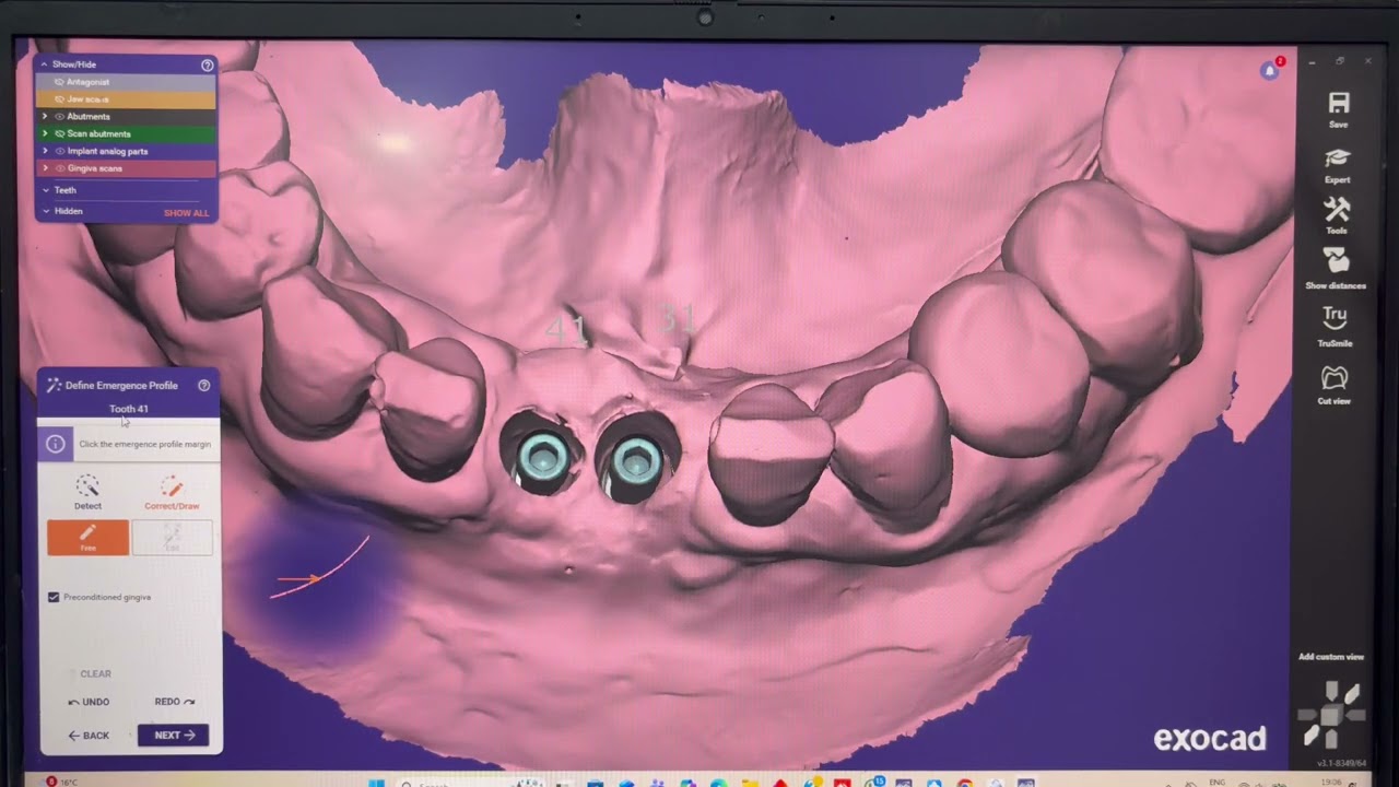 Exocad Tutorial Osstem Implant System Screw-Retained Two Joint Crown Design Step by Step