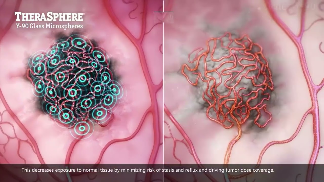 TheraSphere mechanism of action explained