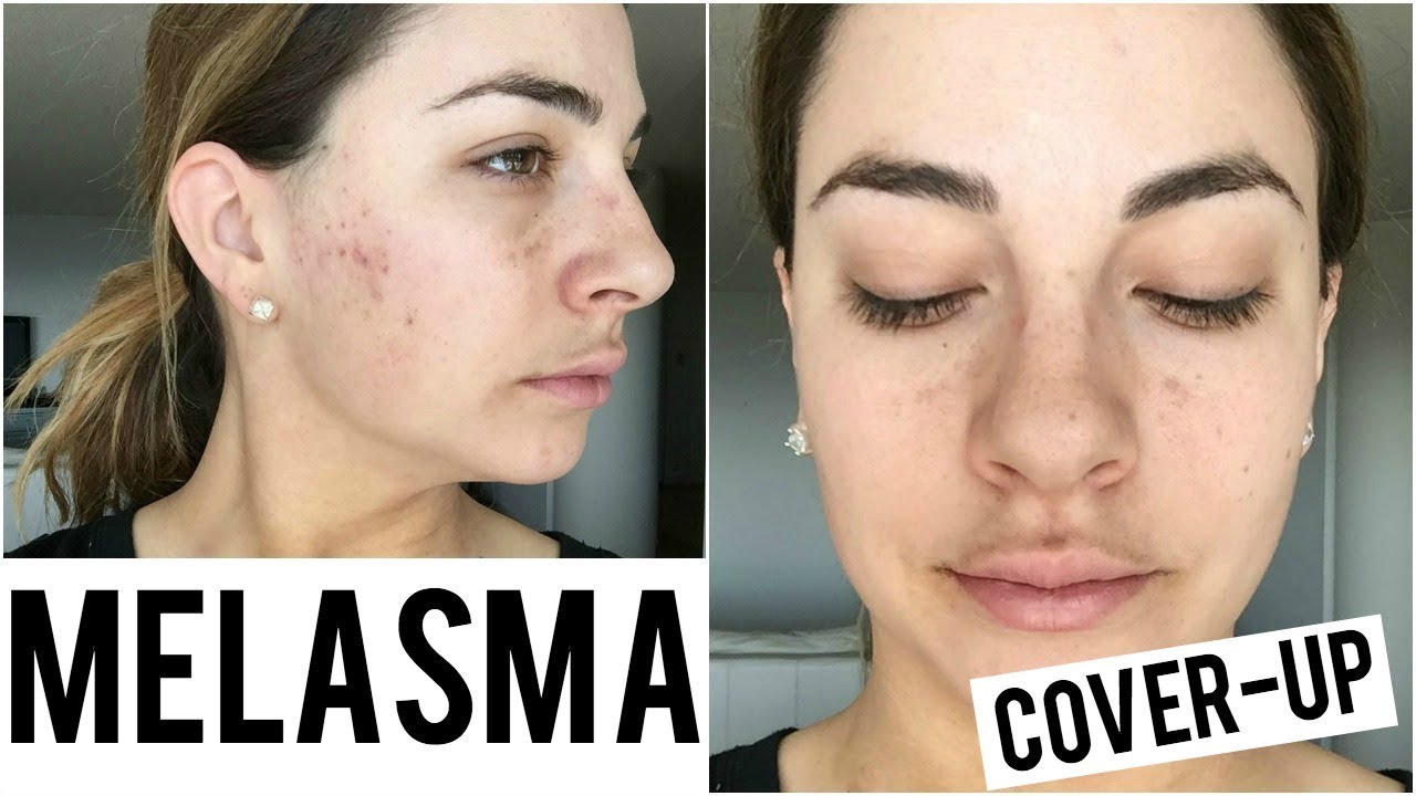 How To Cover Melasma