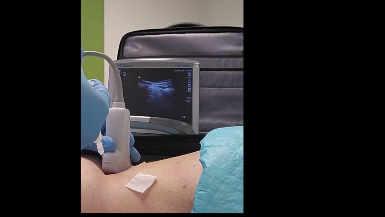Lumbar L4/5 facet joint injection under ultrasound guidance