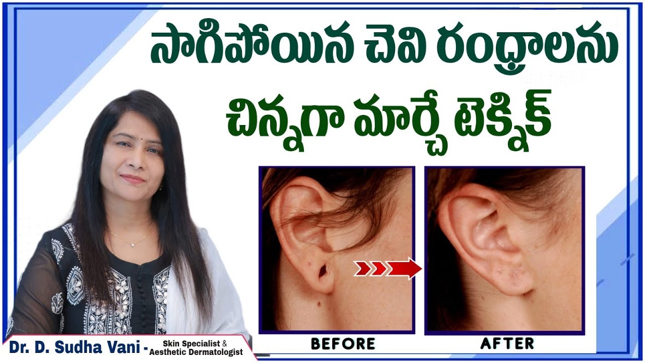 సాగిపోయిన చెవి రంధ్రాలు || How to Repair Earlobe in Telugu || Dr Sudha Vani || Srih Skin Clinic