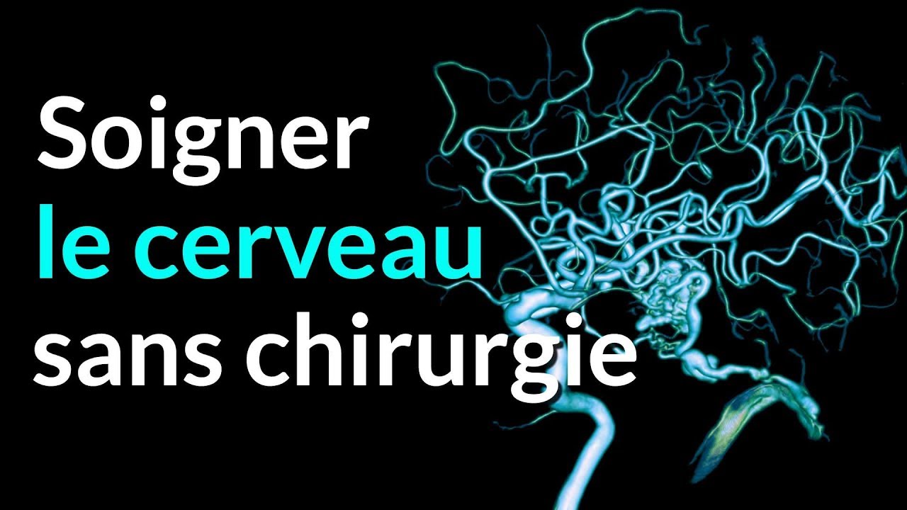 AVC et anévrisme : soigner le cerveau sans chirurgie