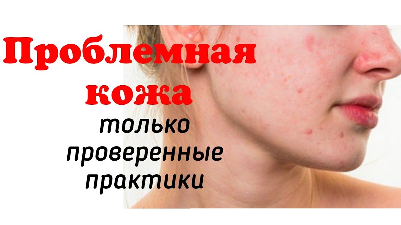 Жирная, себорейная кожа. Лучшие процедуры для борьбы с акне и постакне