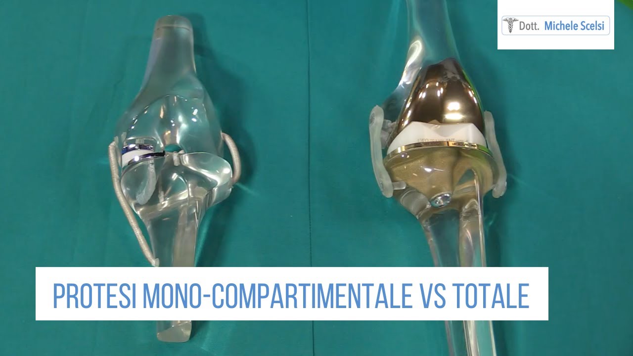 Protesi di ginocchio: mono-compartimentale vs totale