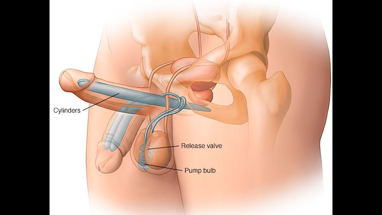 Penile Implant Miami