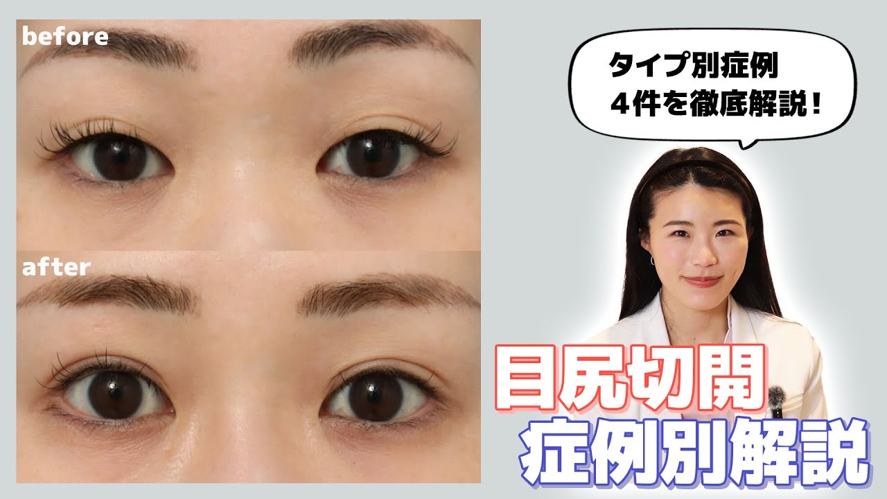 【整形】目尻切開の症例解説✨タレ目＋目が大きくなる術式です｜ヴェリテクリニック