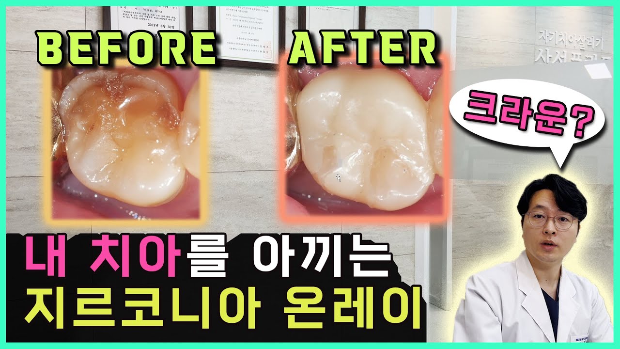 크라운 치료와 온레이, 인레이 무엇을 선택해야 할까요?