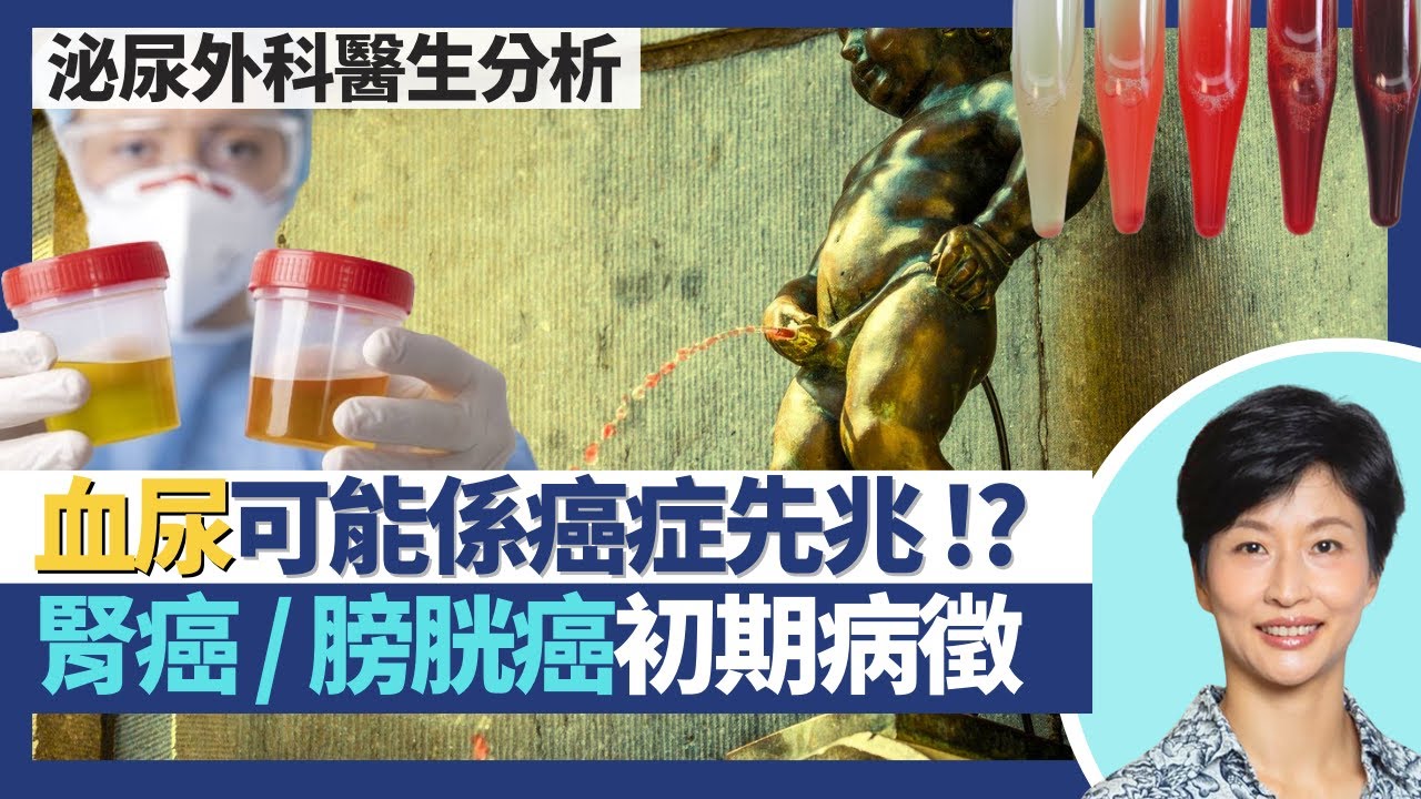 血尿｜小便有血或是癌症先兆 一次血尿都可能是腎癌膀胱癌初期病徵！一情況可致急性尿瀦留須即時急症室求診！部分西藥及食物可令小便變色未必是血尿？｜王建芳醫生 泌尿外科醫生徐學良醫生｜人類健康研究所