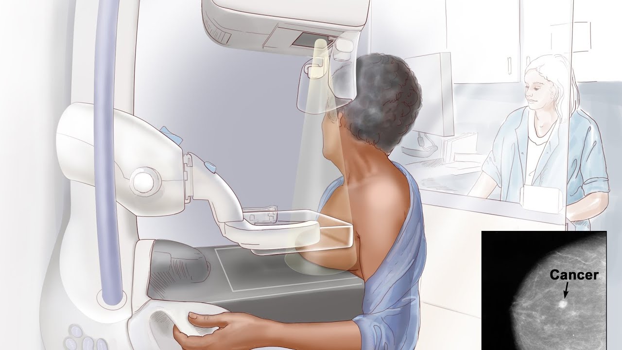 mammography radiology || تصوير الثدي الاشعاعي