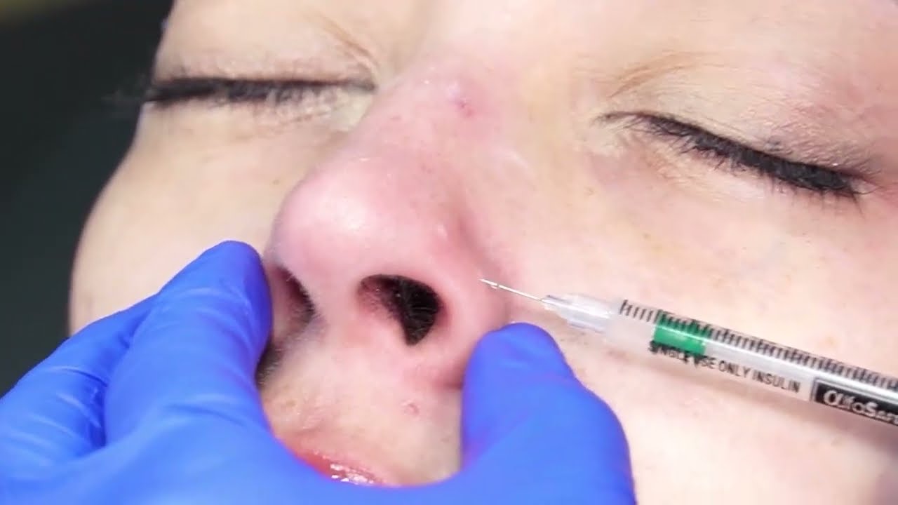 COMO TRATAR LOS MUSCULOS DE LA NARIZ CON TOXINA BOTULINICA - DRA MARIA VICTORIA - PRAXIS STUDIO