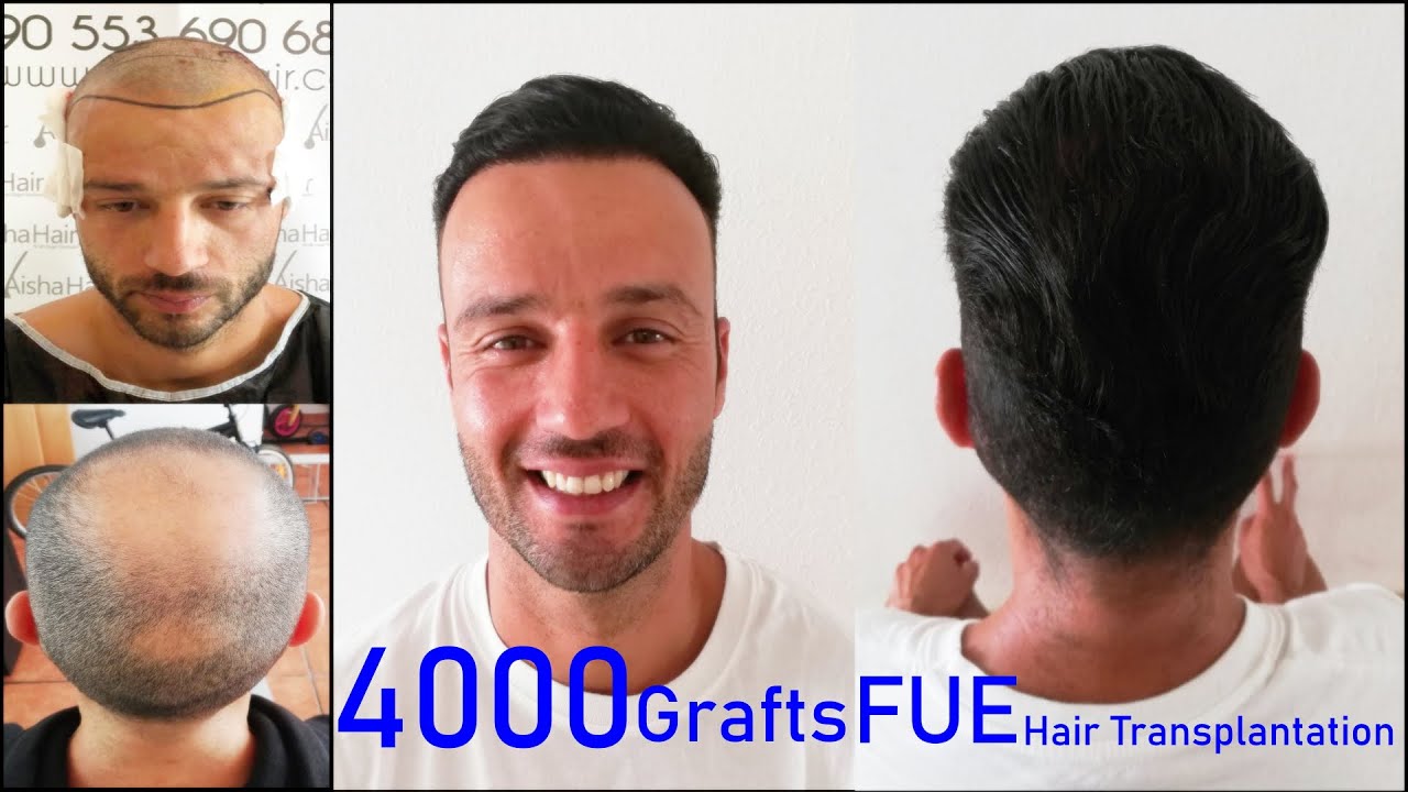 Norwood 4 FUE Hair Transplant / Norwood 4 Injerto Capilar FUE