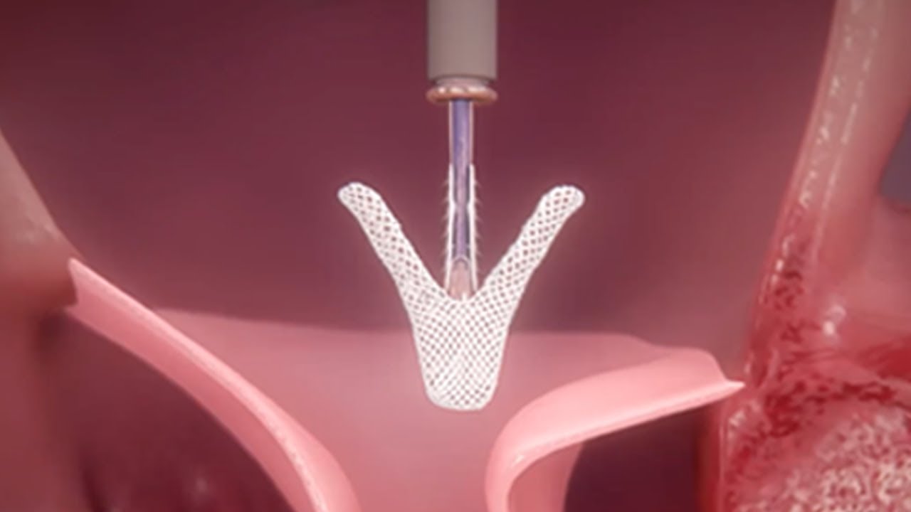 Minimally-Invasive MitraClip&trade; Therapy: How Does It Work?