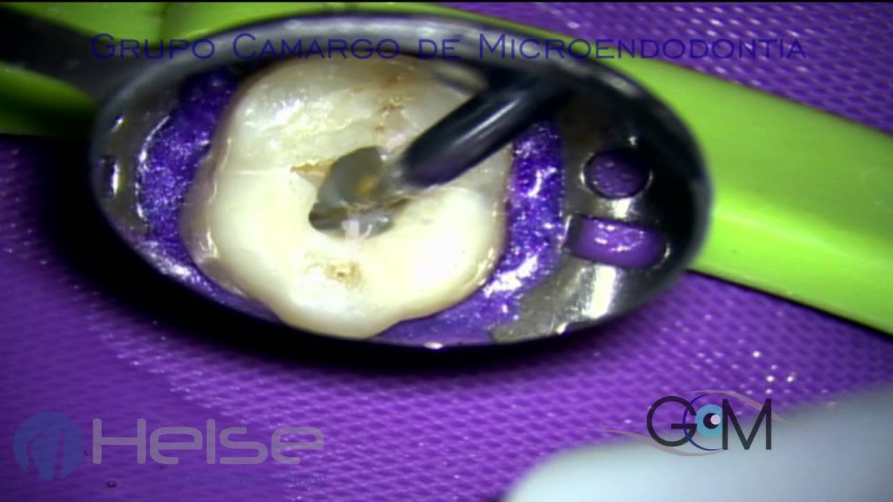 Helse - E1 IRRISONIC - Ultrasonic Activation of Irrigation