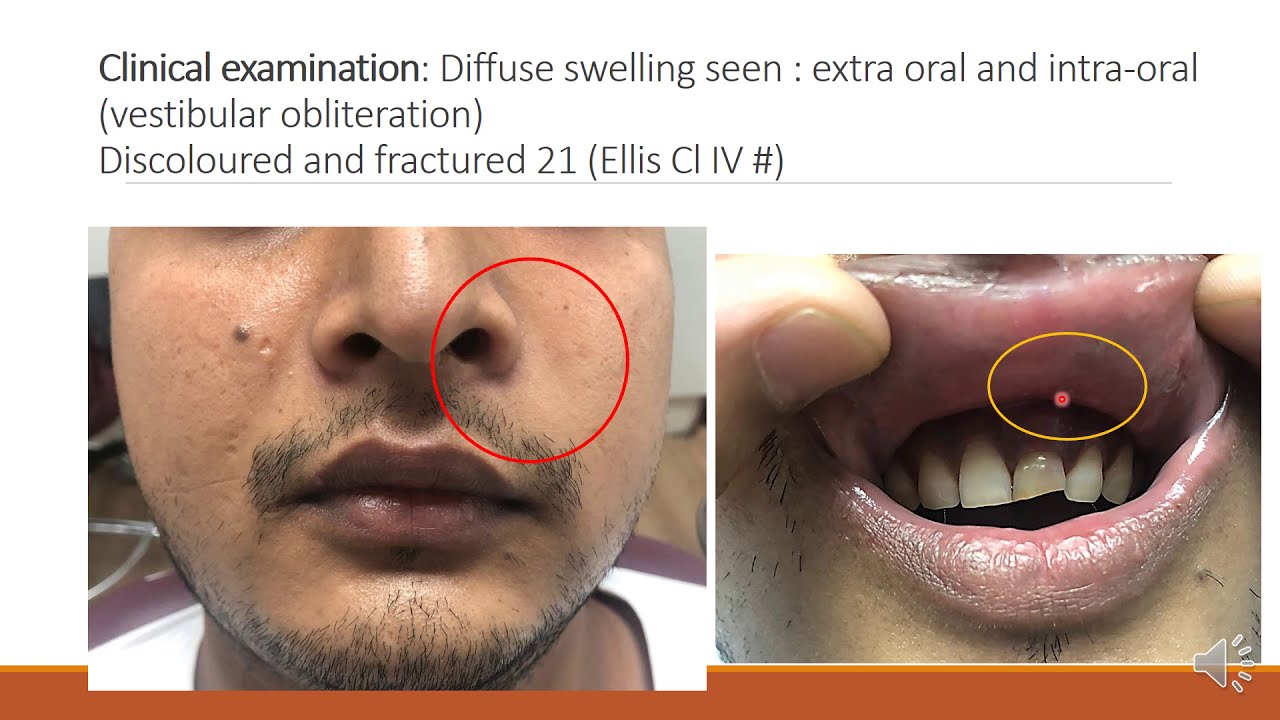 Case Discussion Acute dental abscess